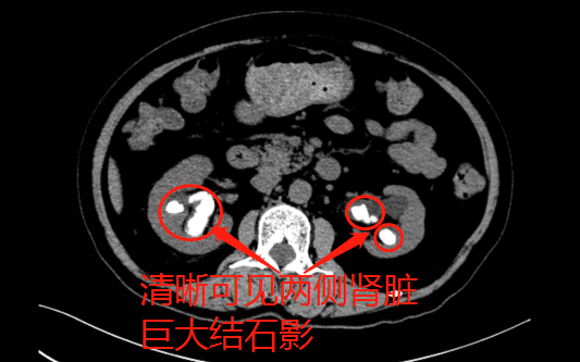 中山碎石，中山激光碎石，中山激光碎石哪家好